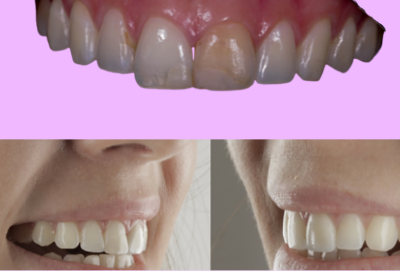 Restaurações Dentárias