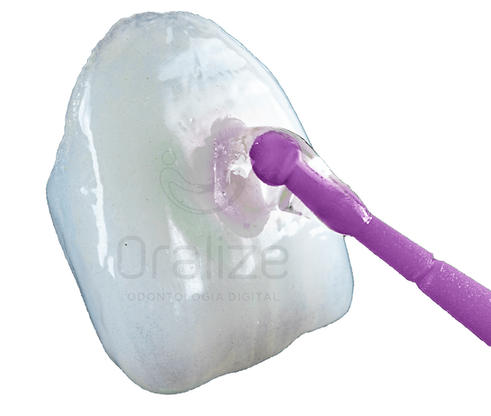 Lentes de Contato Dental