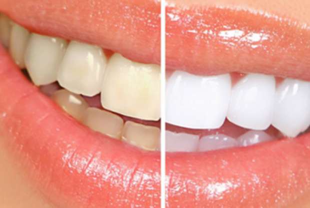 Escala de Clareamento Dental